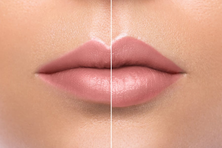 Comparison of female lips after augmentation